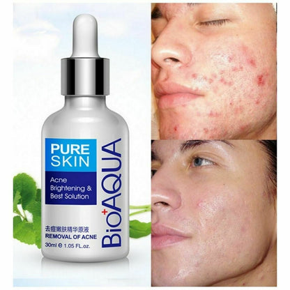 BIOAQUA 30ml Anti Acne Serum, Hydrating Oil Control Nourishing Facial Treatment